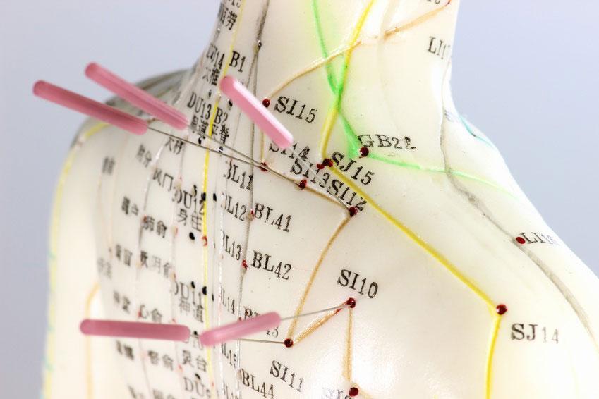 Acupuncture for Boosting Immunity: How to Stay Healthy Naturally